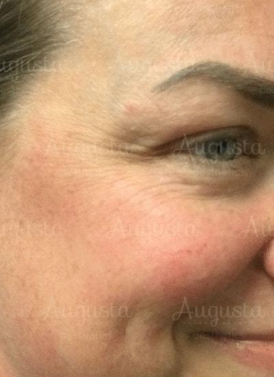 Botox before at Augusta Aesthetics in Cincinnati, OH