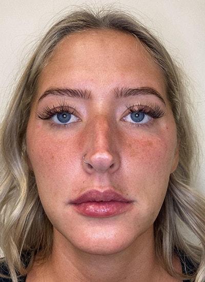 Augusta Aesthetics lip filler after — Cincinnati, OH