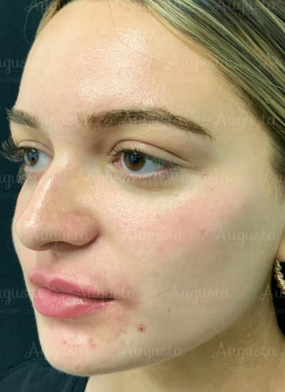 Augusta Aesthetics after — Cincinnati, OH