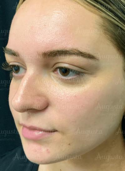 Juvederm before at Augusta Aesthetics in Cincinnati, OH