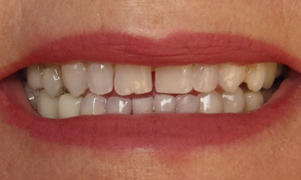 Gum Contouring before at Dr. Rick Dentistry in Scottsdale, AZ