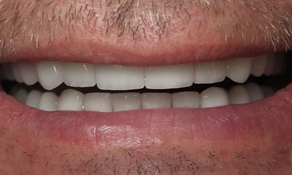 Dr. Rick Dentistry smile makeover after — Scottsdale, AZ