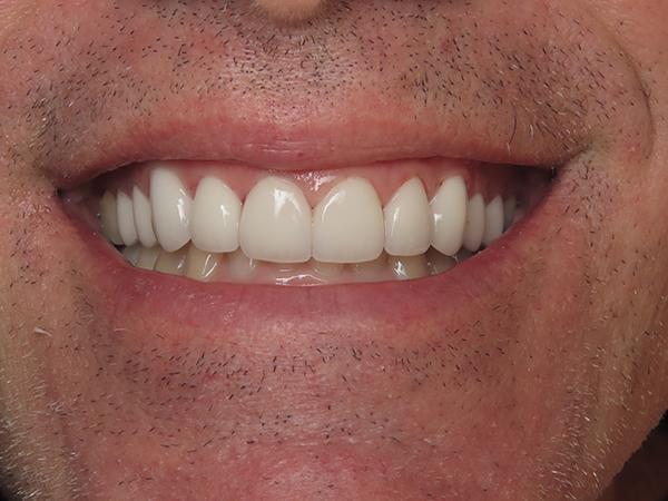 Dr. Rick Dentistry smile makeover after — Scottsdale, AZ