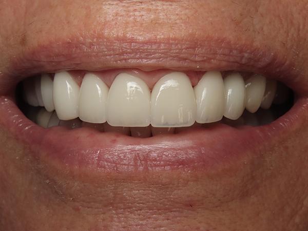 Dr. Rick Dentistry smile makeover after — Scottsdale, AZ