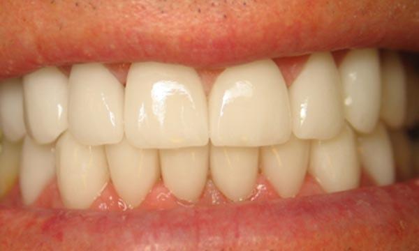 Dental Crowns after at Dr. Rick Dentistry in Scottsdale, AZ