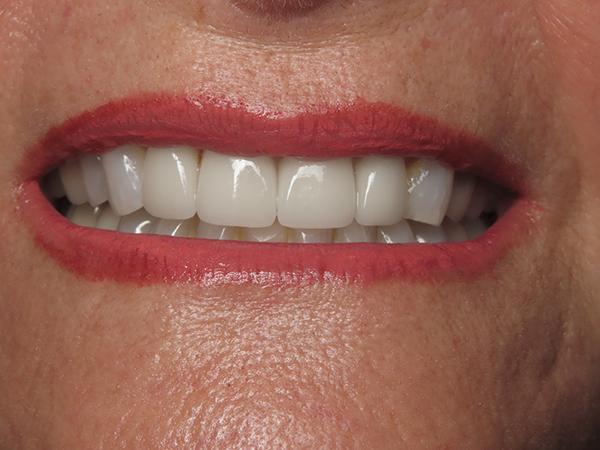 Dr. Rick Dentistry smile makeover after — Scottsdale, AZ