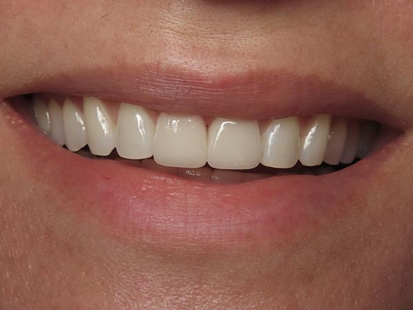 Dr. Rick Dentistry smile makeover after — Scottsdale, AZ