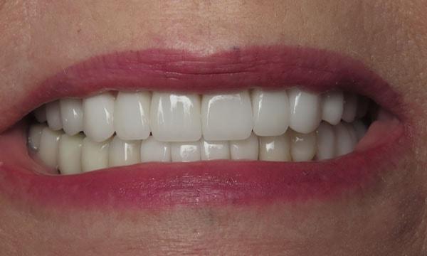 Gum Contouring after at Dr. Rick Dentistry in Scottsdale, AZ