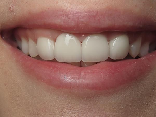 Dr. Rick Dentistry smile makeover after — Scottsdale, AZ