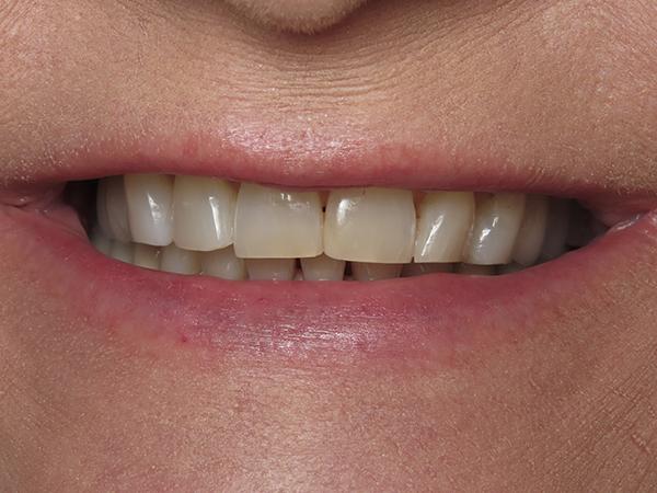 Smile Makeover before at Dr. Rick Dentistry in Scottsdale, AZ