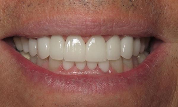 Dr. Rick Dentistry smile makeover after — Scottsdale, AZ