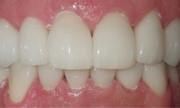 Dr. Rick Dentistry smile makeover after — Scottsdale, AZ