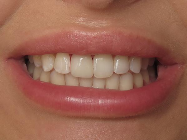 Dr. Rick Dentistry smile makeover after — Scottsdale, AZ