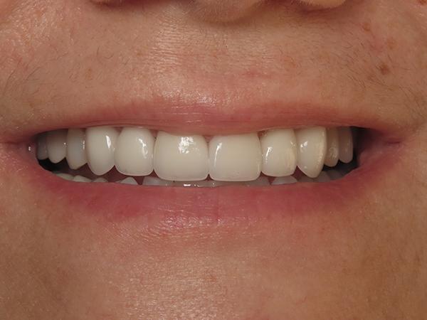 Dr. Rick Dentistry smile makeover after — Scottsdale, AZ