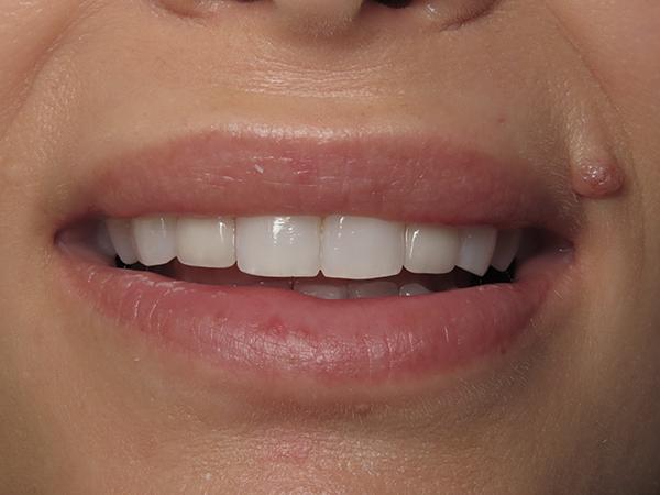 Dr. Rick Dentistry smile makeover after — Scottsdale, AZ