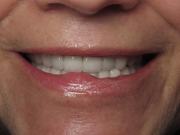 Dr. Rick Dentistry smile makeover after — Scottsdale, AZ