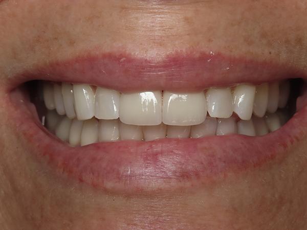 Dr. Rick Dentistry smile makeover after — Scottsdale, AZ