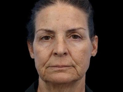 Neck Lift before at Defyne Plastic Surgery in Scottsdale, AZ