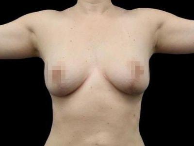 Breast Lift after at Defyne Plastic Surgery in Scottsdale, AZ