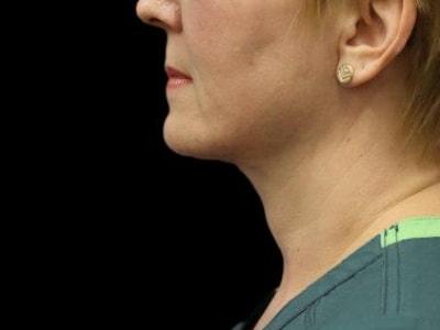 Neck Lift after at Defyne Plastic Surgery in Scottsdale, AZ