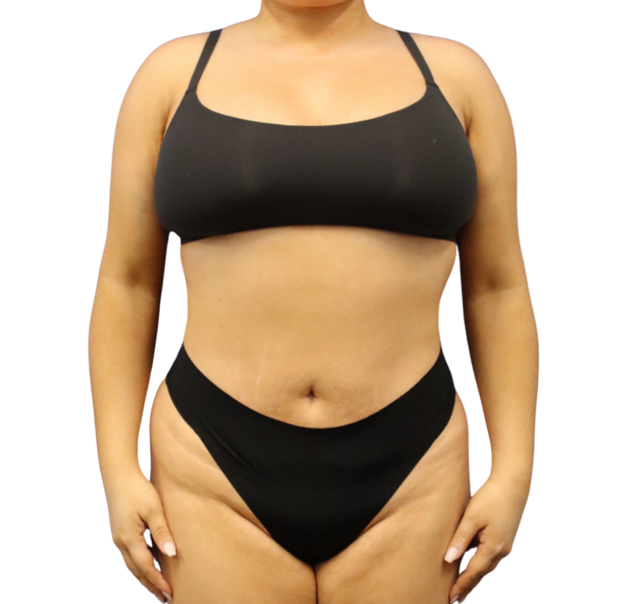 Tummy Tuck after at Defyne Plastic Surgery in Scottsdale, AZ