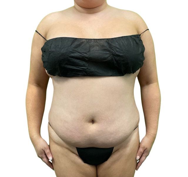 Tummy Tuck before at Defyne Plastic Surgery in Scottsdale, AZ