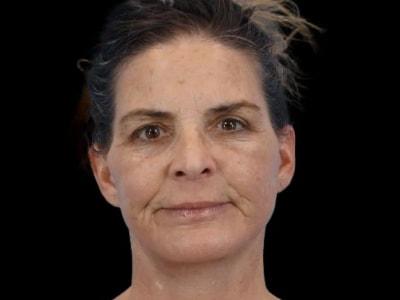 Neck Lift after at Defyne Plastic Surgery in Scottsdale, AZ