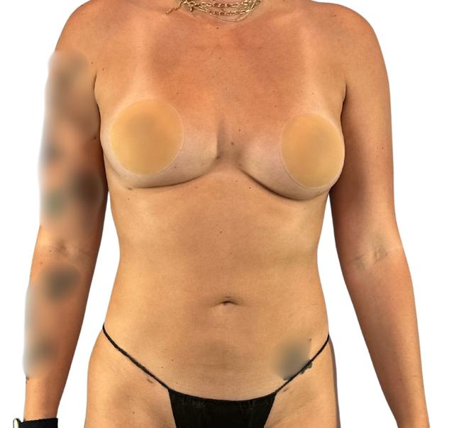 Liposuction after at Defyne Plastic Surgery in Scottsdale, AZ