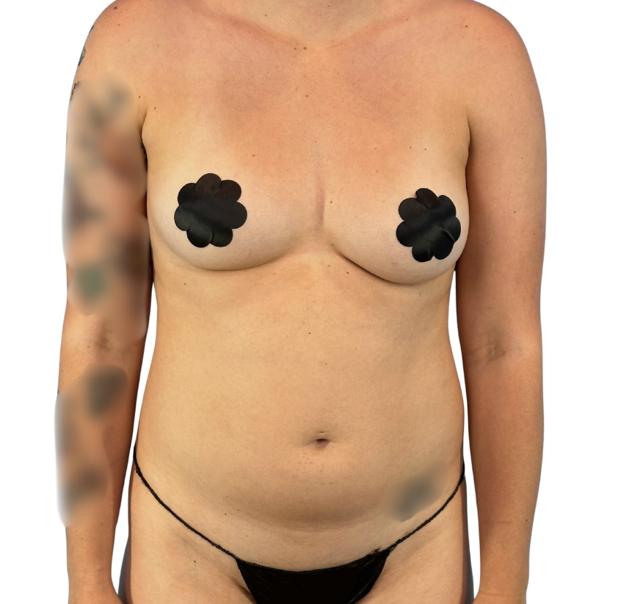 Liposuction before at Defyne Plastic Surgery in Scottsdale, AZ