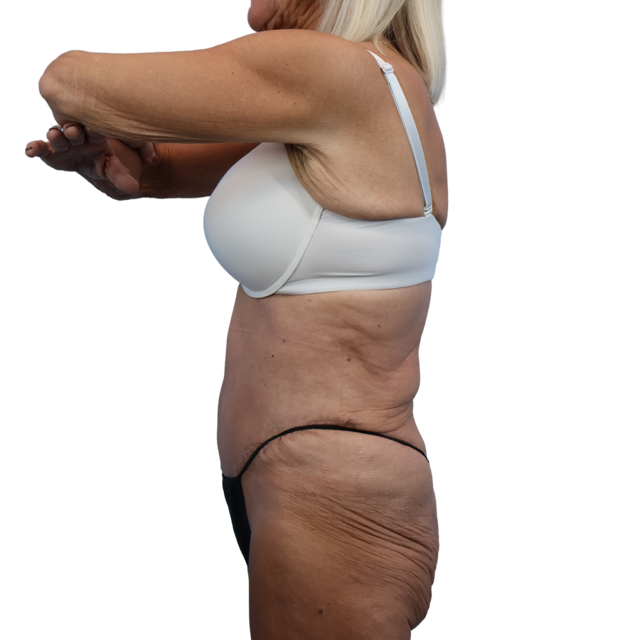 Tummy Tuck after at Defyne Plastic Surgery in Scottsdale, AZ