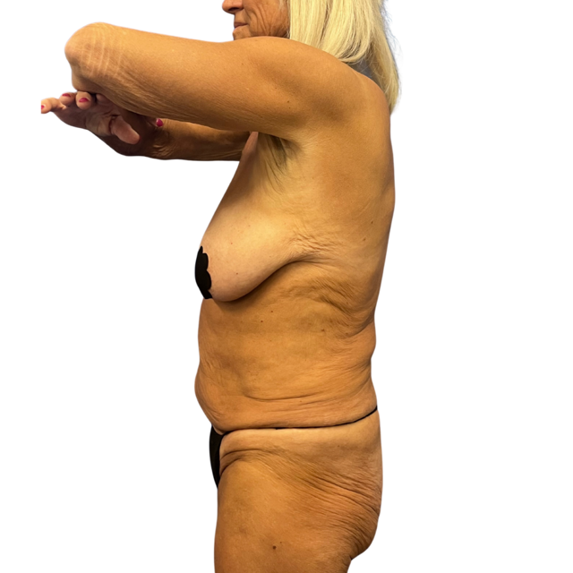 Tummy Tuck before at Defyne Plastic Surgery in Scottsdale, AZ