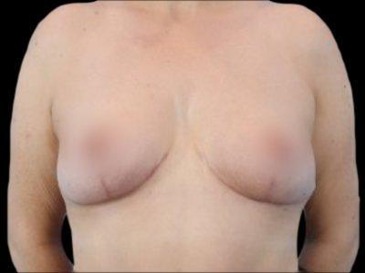 Breast Lift after at Defyne Plastic Surgery in Scottsdale, AZ