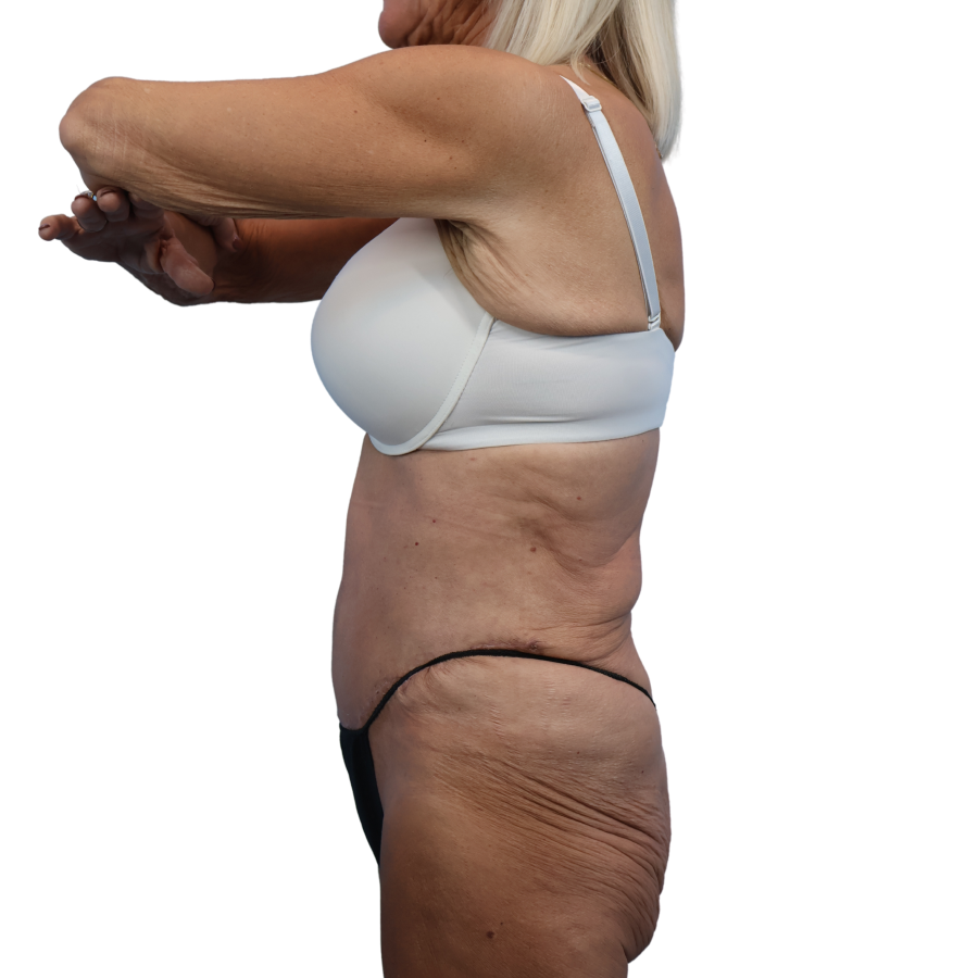 Defyne Plastic Surgery after — Scottsdale, AZ