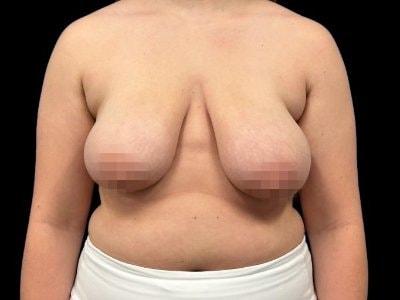 Breast Lift before at Defyne Plastic Surgery in Scottsdale, AZ