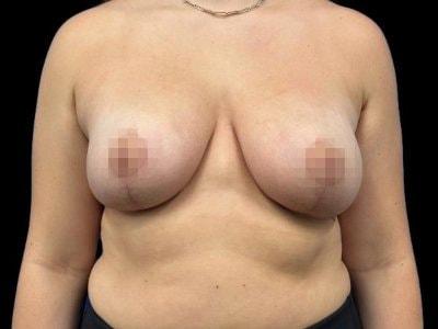 Breast Lift after at Defyne Plastic Surgery in Scottsdale, AZ