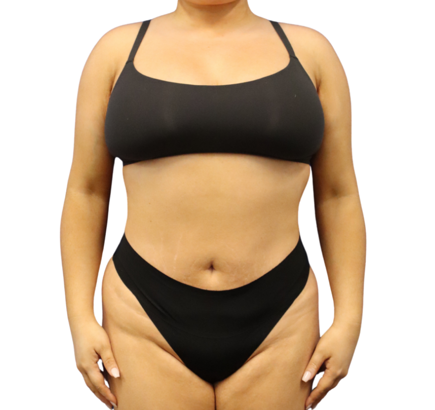 Defyne Plastic Surgery after — Scottsdale, AZ