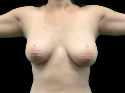 Breast Lift before at Defyne Plastic Surgery in Scottsdale, AZ