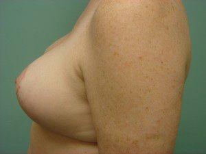 Aspira Plastic Surgery & Med Spa: Dr. Venkata Erella breast lift result — Austin, TX