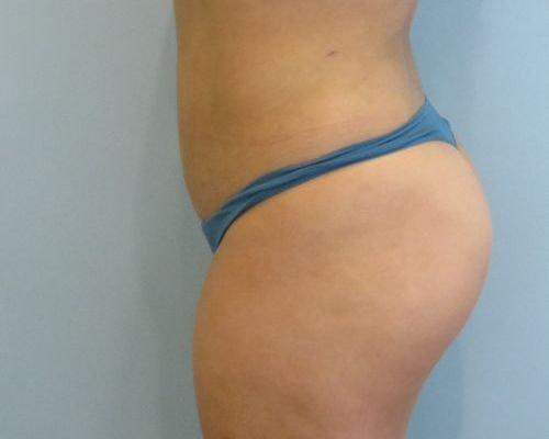 Liposuction after at Aspira Plastic Surgery & Med Spa: Dr. Venkata Erella in Austin, TX