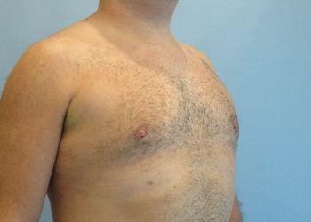 Aspira Plastic Surgery & Med Spa: Dr. Venkata Erella gynecomastia after — Austin, TX
