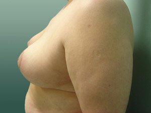 Aspira Plastic Surgery & Med Spa: Dr. Venkata Erella breast reduction result — Austin, TX