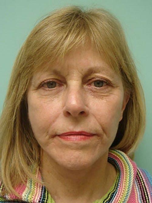 Facelift after at Aspira Plastic Surgery & Med Spa: Dr. Venkata Erella in Austin, TX
