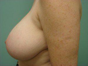 Breast Lift result at Aspira Plastic Surgery & Med Spa: Dr. Venkata Erella in Austin, TX