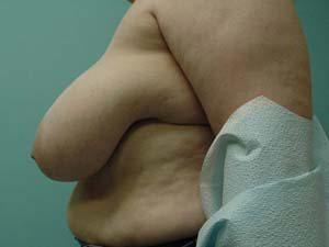 Aspira Plastic Surgery & Med Spa: Dr. Venkata Erella breast reduction result — Austin, TX