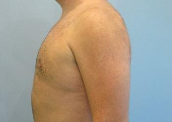 Aspira Plastic Surgery & Med Spa: Dr. Venkata Erella gynecomastia after — Austin, TX