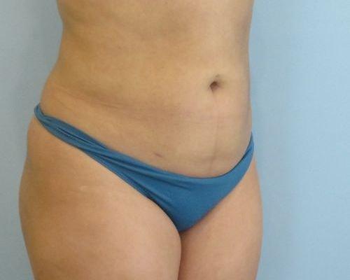 Liposuction after at Aspira Plastic Surgery & Med Spa: Dr. Venkata Erella in Austin, TX