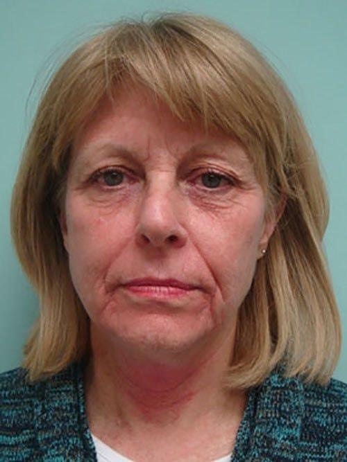 Facelift before at Aspira Plastic Surgery & Med Spa: Dr. Venkata Erella in Austin, TX