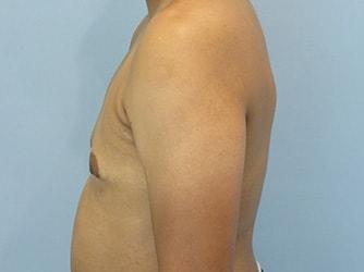 Aspira Plastic Surgery & Med Spa: Dr. Venkata Erella gynecomastia after — Austin, TX