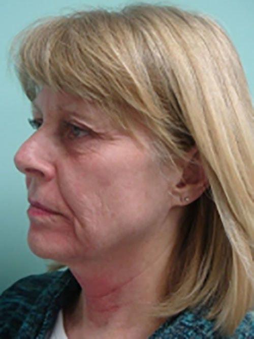 Facelift before at Aspira Plastic Surgery & Med Spa: Dr. Venkata Erella in Austin, TX