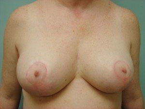 Aspira Plastic Surgery & Med Spa: Dr. Venkata Erella breast lift result — Austin, TX